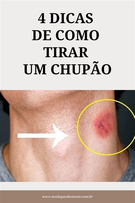 como tirar chupada|Como Tirar Marca de Chupão: Dicas e Truques Eficazes